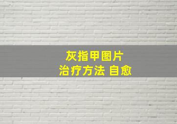 灰指甲图片 治疗方法 自愈